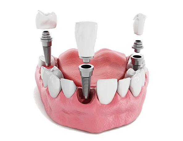 Dental Implants